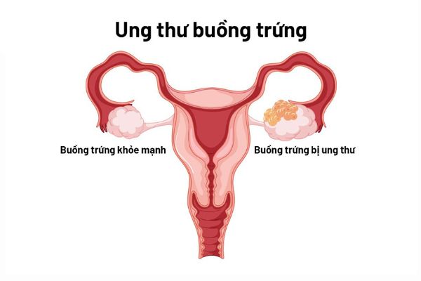 Tong-hop-cac-benh-buong-trung-thuong-gap-07