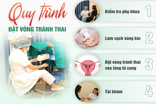 Quy trình đặt vòng tránh thai đúng chuẩn khoa học tại Đa khoa Quy Nhơn