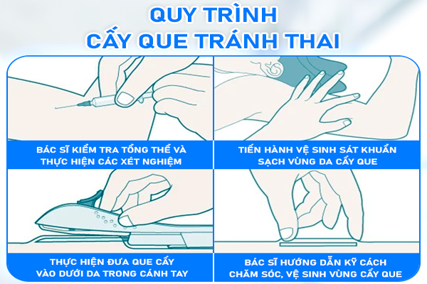 Quy trình cấy que tránh thai đạt chuẩn y tế tại Quy Nhơn