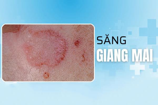 nhan-biet-hinh-anh-benh-giang-mai-giai-doan-dau-1