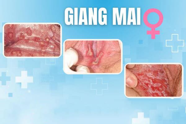 nhan-biet-hinh-anh-benh-giang-mai-giai-doan-dau-2