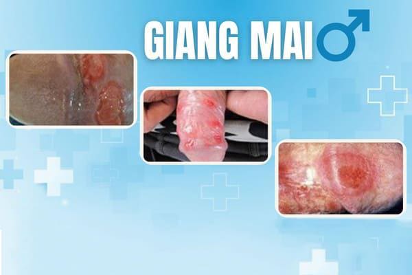 nhan-biet-hinh-anh-benh-giang-mai-giai-doan-dau-3