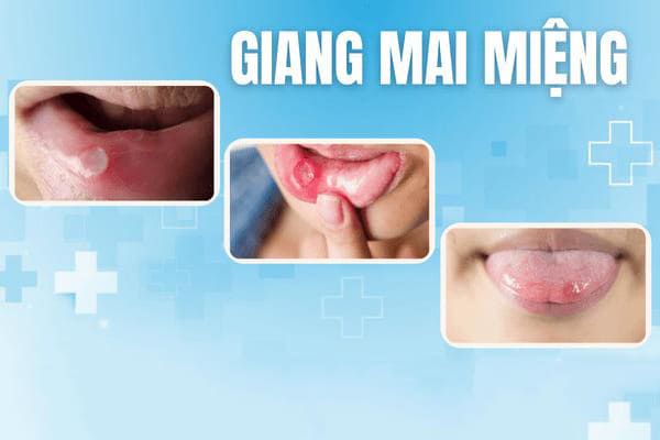 nhan-biet-hinh-anh-benh-giang-mai-giai-doan-dau-4