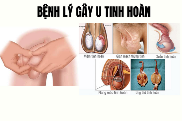 u-tinh-hoan-la-benh-gi-dieu-tri-nhu-the-nao-2