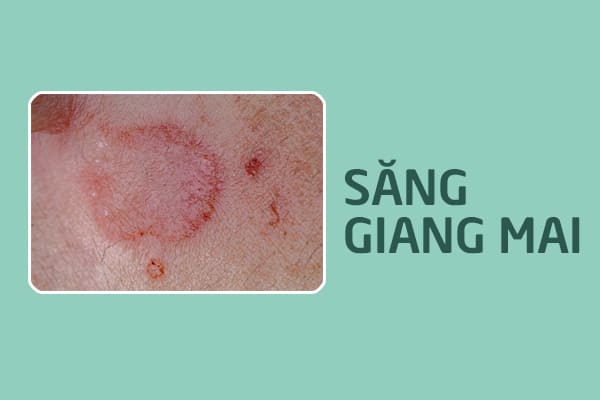 xac-dinh-thoi-gian-u-benh-giang-mai-1