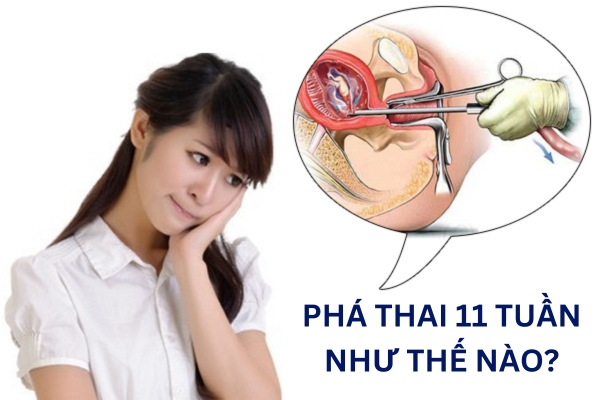 Phá thai 11 tuần như thế nào?
